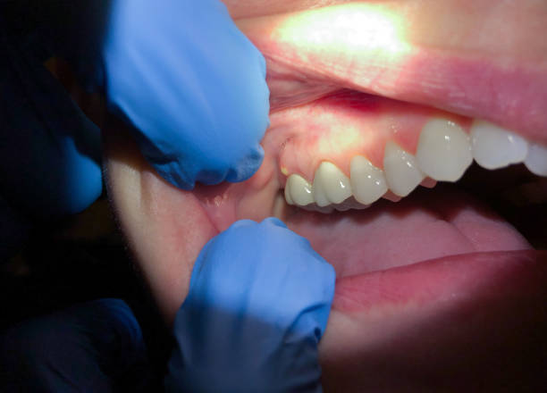 Best Emergency Wisdom Tooth Extraction in Detroit Beach, MI